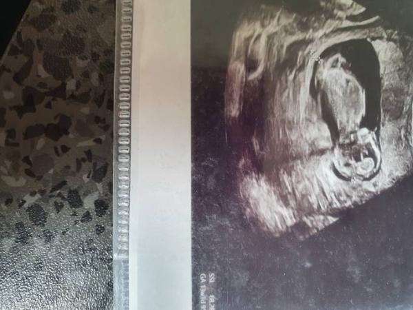 Bild zu Nackenfalte - Schwanger mit 35 plus - Forum