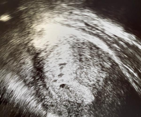 Bild zu Eileiterschwangerschaft oder doch alles ok? - Schwanger mit 35 plus - Forum
