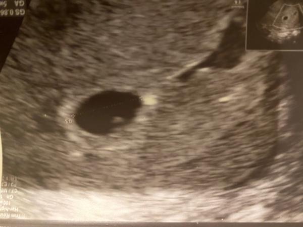 Bild zu Ultraschall 5+4 zeitgemäß? - Schwanger mit 35 plus - Forum