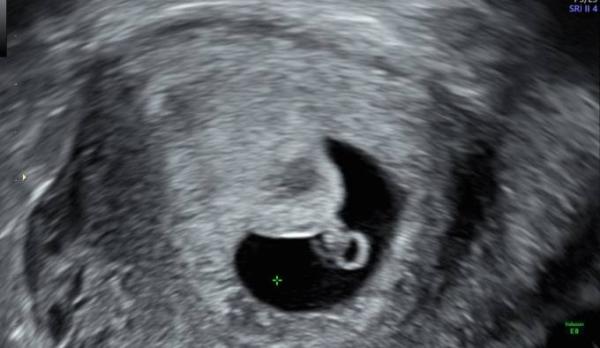 Bild zu Ungewöhnlicher erster Ultraschall - Schwanger mit 35 plus - Forum