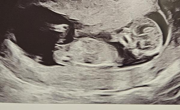 Bild zu Nub-Theorie - Schwanger mit 35 plus - Forum