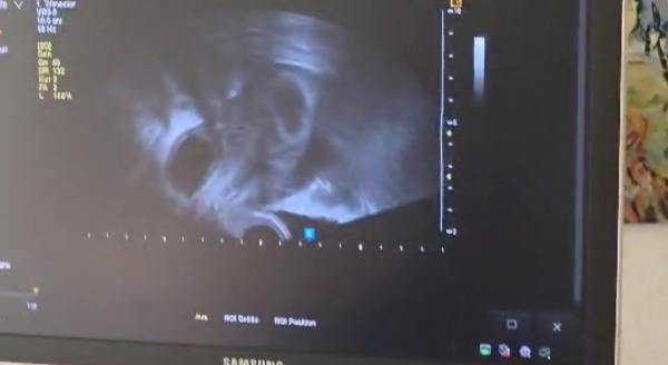 Bild zu Sind das 2 Fruchthöhlen? - Schwanger mit 35 plus - Forum