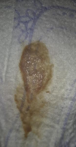 Bild zu Ausfluss, Blut?    -Achtung Foto - Schwanger mit 35 plus - Forum