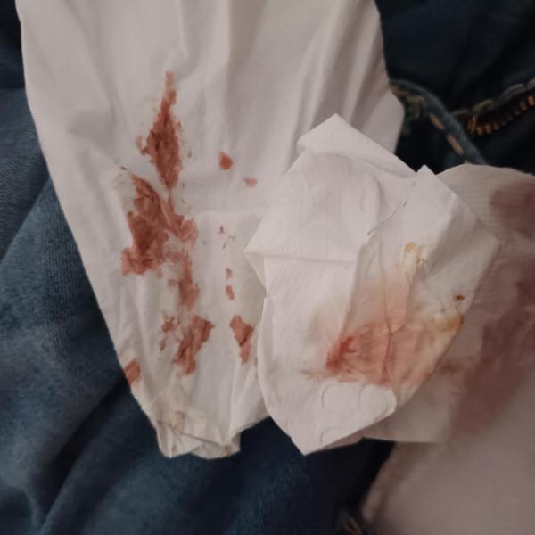 Bild zu Achtung Bild!!Schmierblutung nach harten Stuhlgang - Schwanger mit 35 plus - Forum