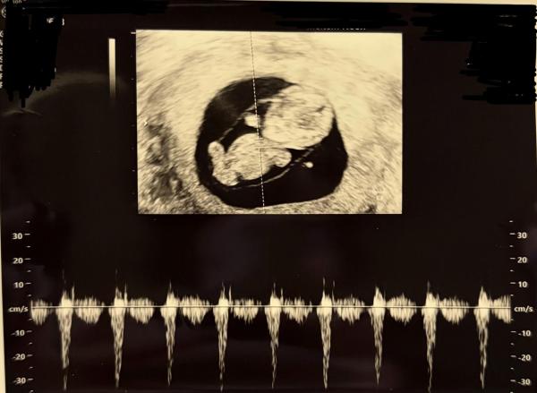 Bild zu SSW 10+0 - gelockertes Gewebe an der Plazenta - Schwanger mit 35 plus - Forum