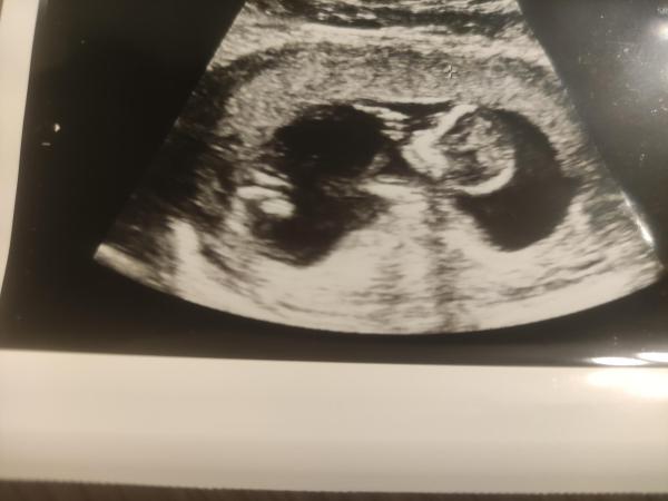 Bild zu Würde mich freuen über Tipps zum Baby Geschlecht - Schwanger mit 35 plus - Forum