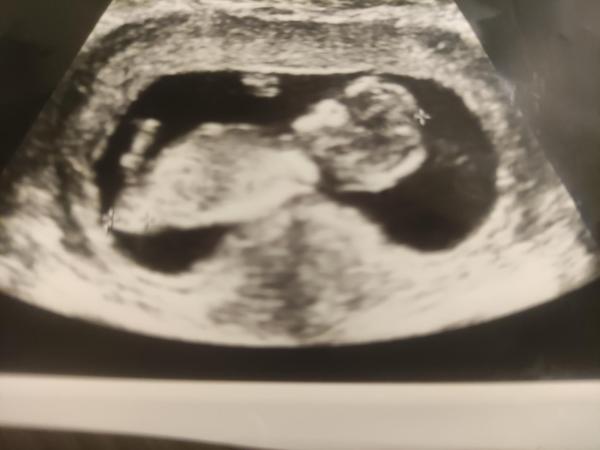 Bild zu Würde mich freuen über Tipps zum Baby Geschlecht - Schwanger mit 35 plus - Forum