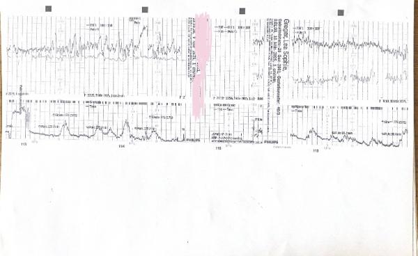 Bild zu Kennt sich jemand mit CTGs aus ? - Geburtsverlauf und Geburtsberichte