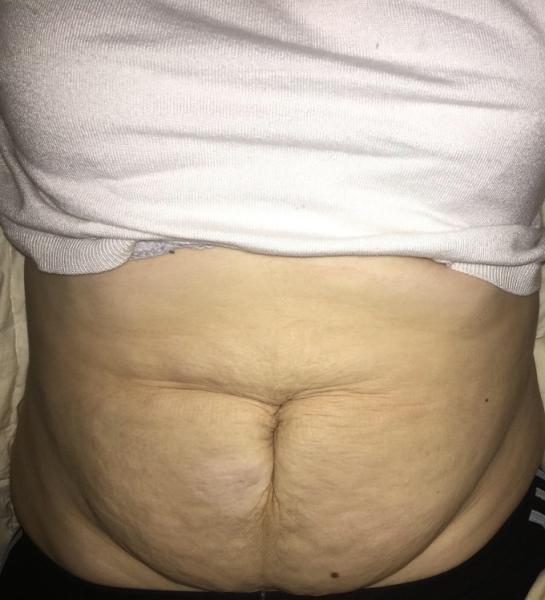 Bild zu Bauch nach Schwangerschaft - Kaiserschnitt - Forum