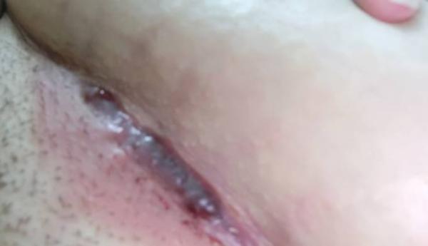Bild zu Kaiserschnitt ca 3 Wochen her ist das normal ? - Kaiserschnitt - Forum