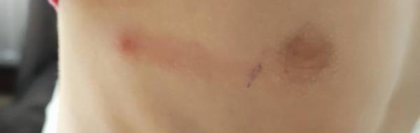 Bild zu Lymphangitis? - Kigakids