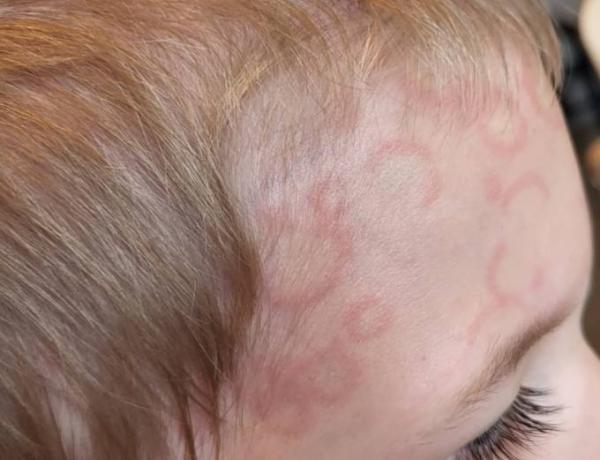 Bild zu Ausschlag? - Kigakids