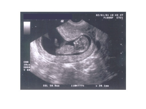 ultraschall woche 12