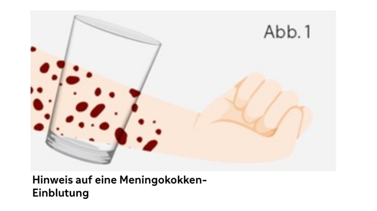 Glastest Meningokokken