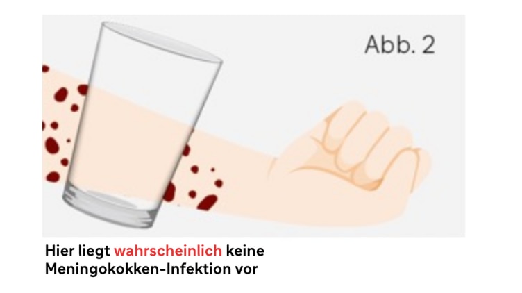 Glastest keine Meningokokken