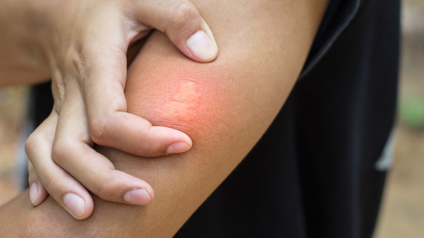 Close-up of bee sting stuck in human skin