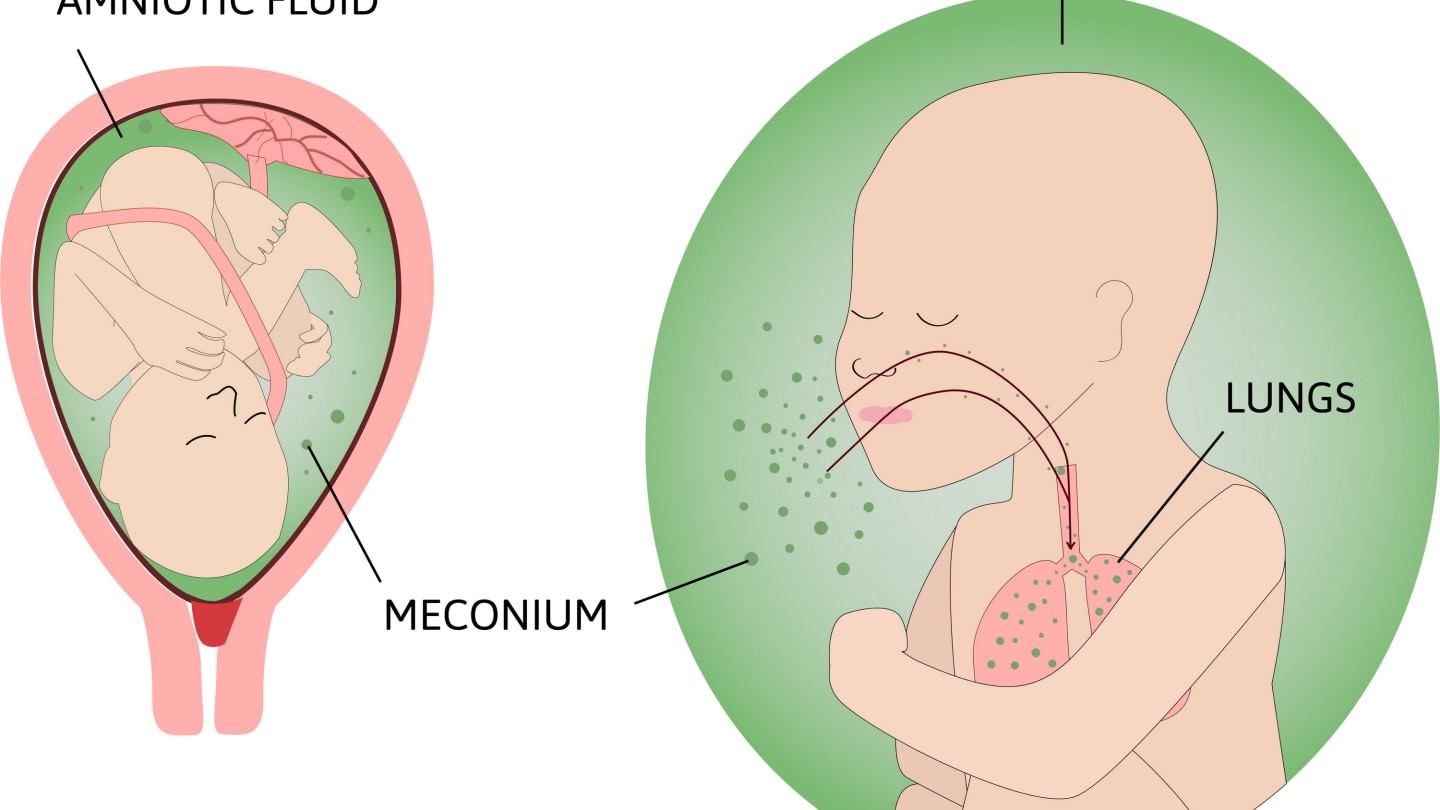 process of Meconium aspiration syndrome