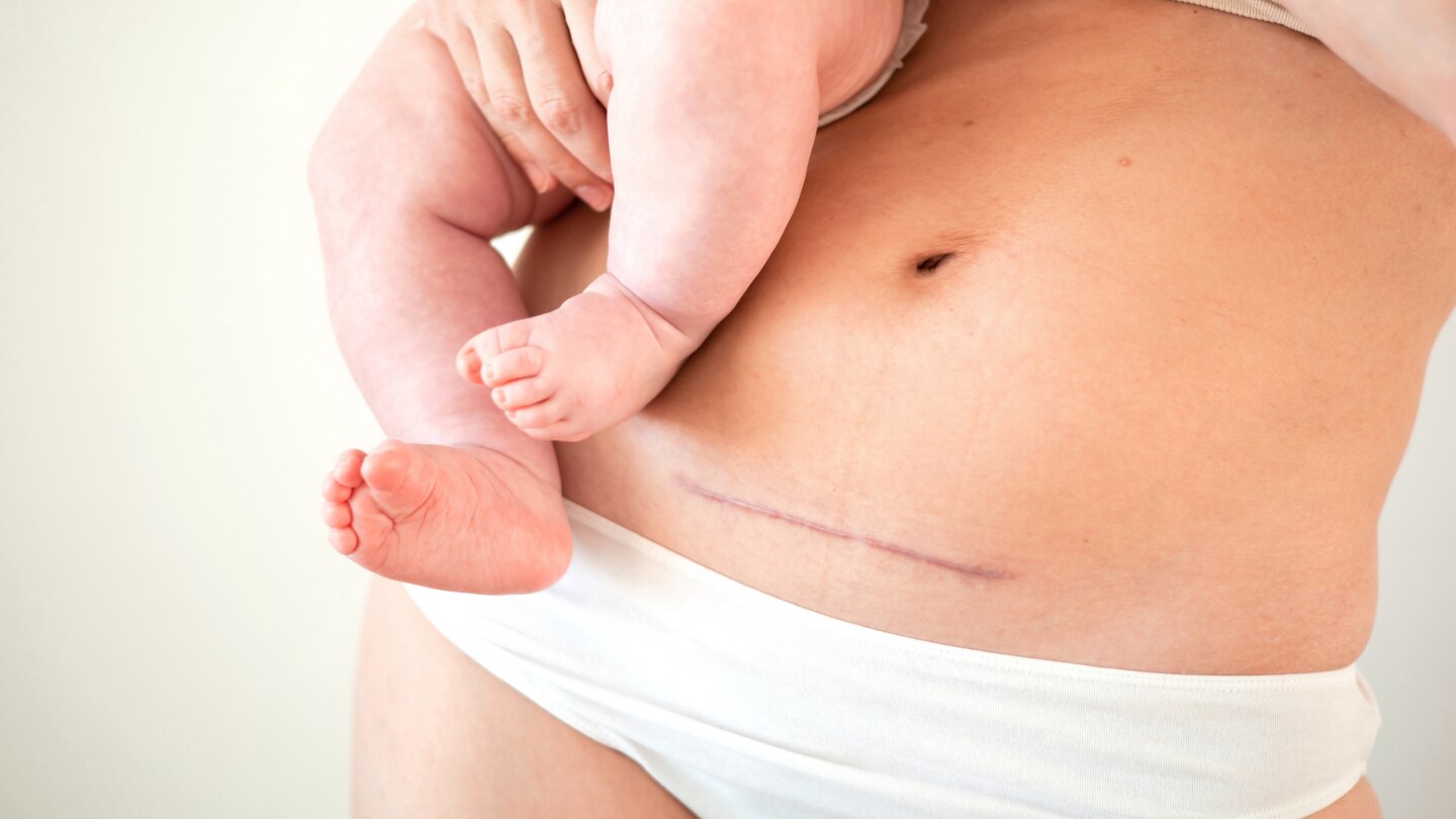 Mom's abdomen after cesarean section