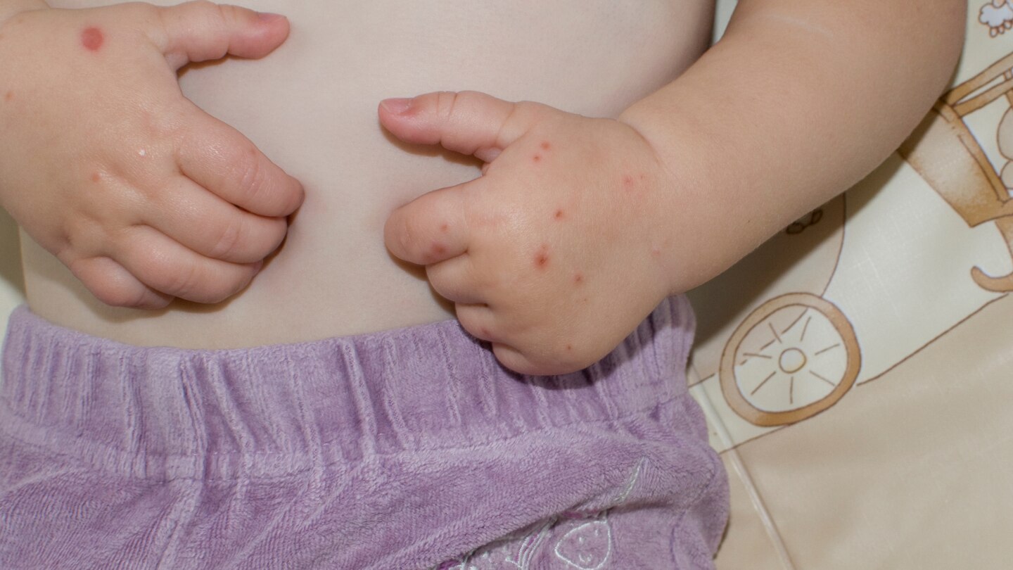 Hand-Mund-Fuß-Krankheit