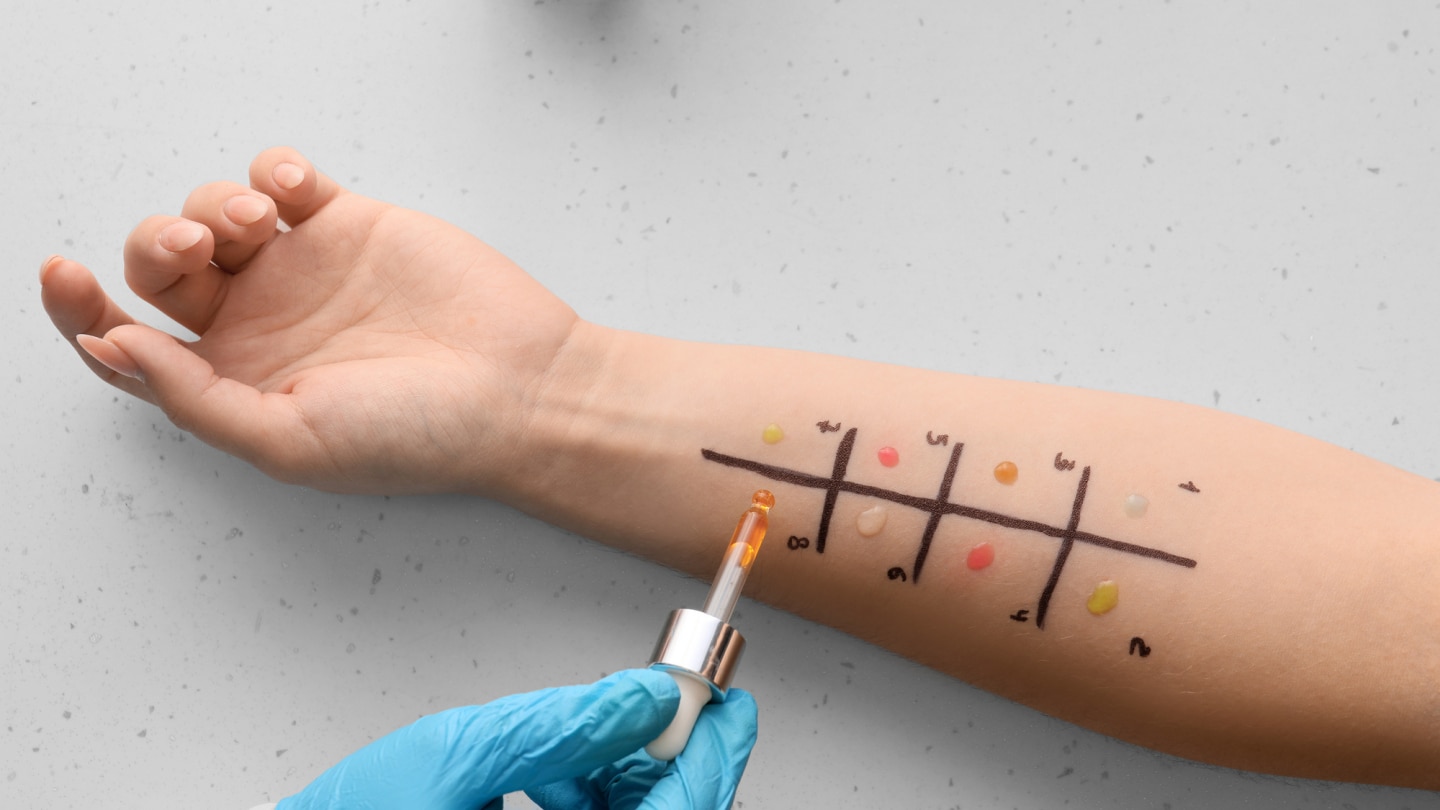 allergietest auf dem unterarm