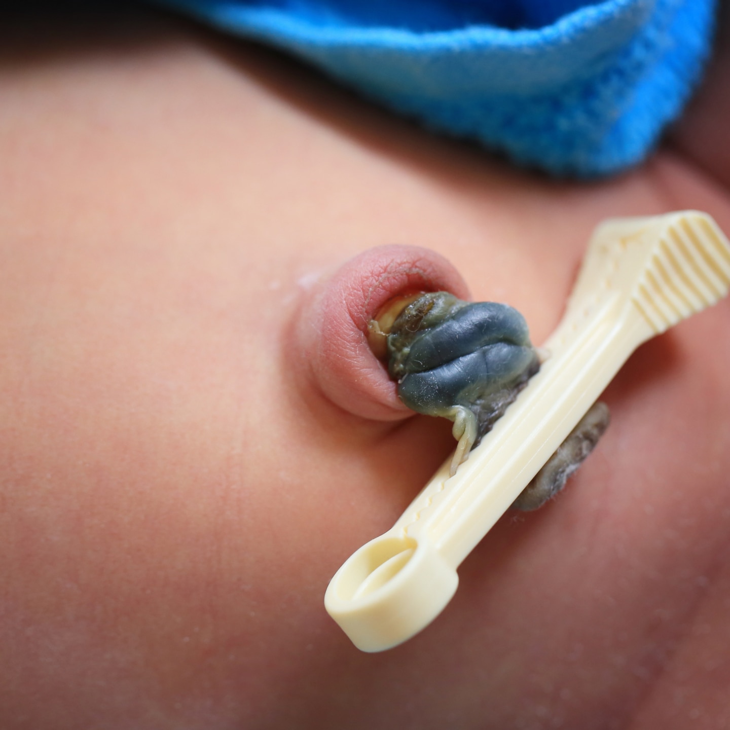 Nabelschnur abgetrennt