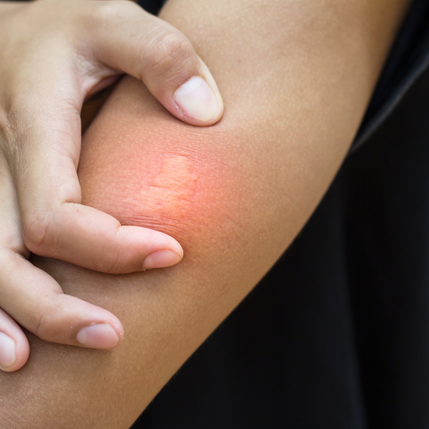 Close-up of bee sting stuck in human skin