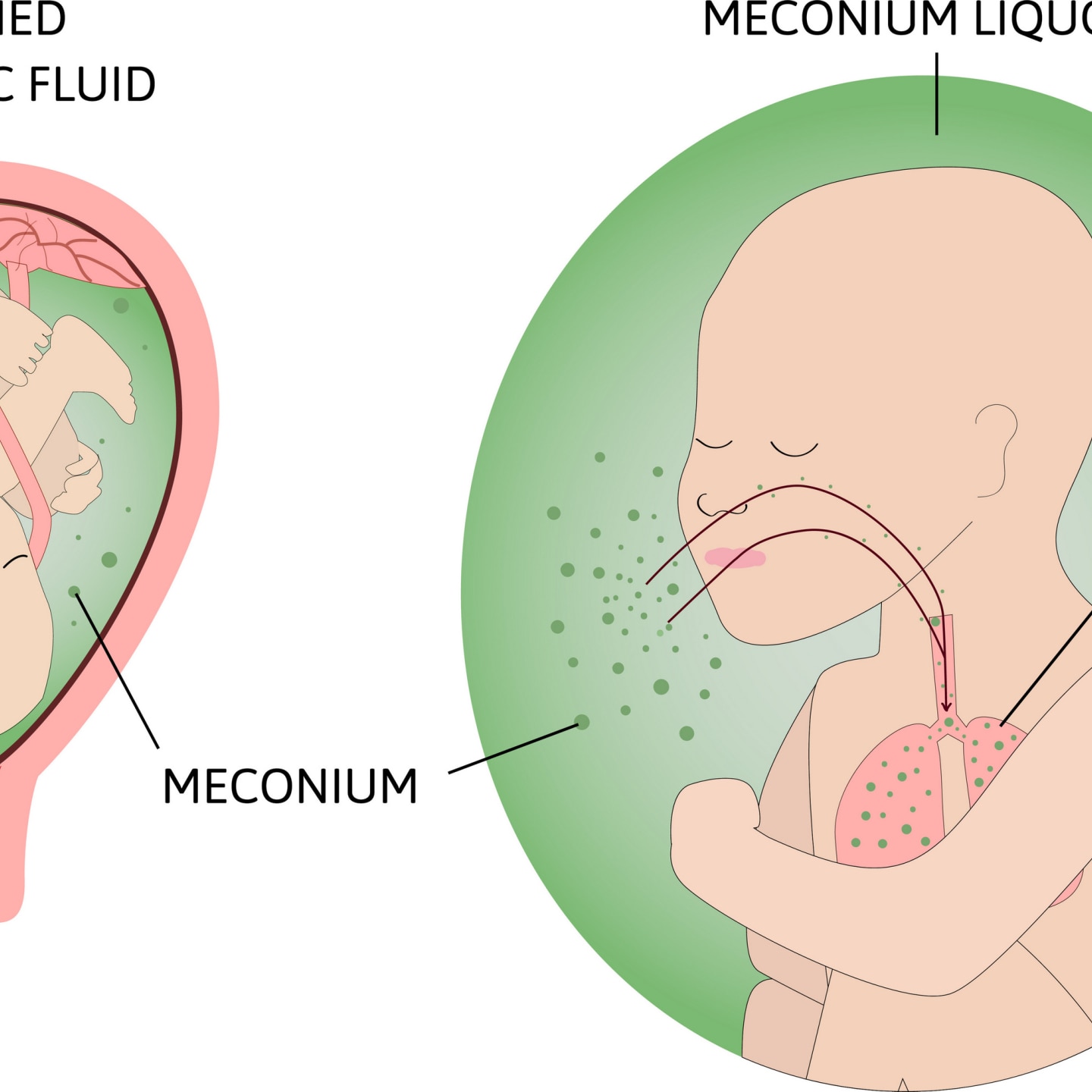 process of Meconium aspiration syndrome