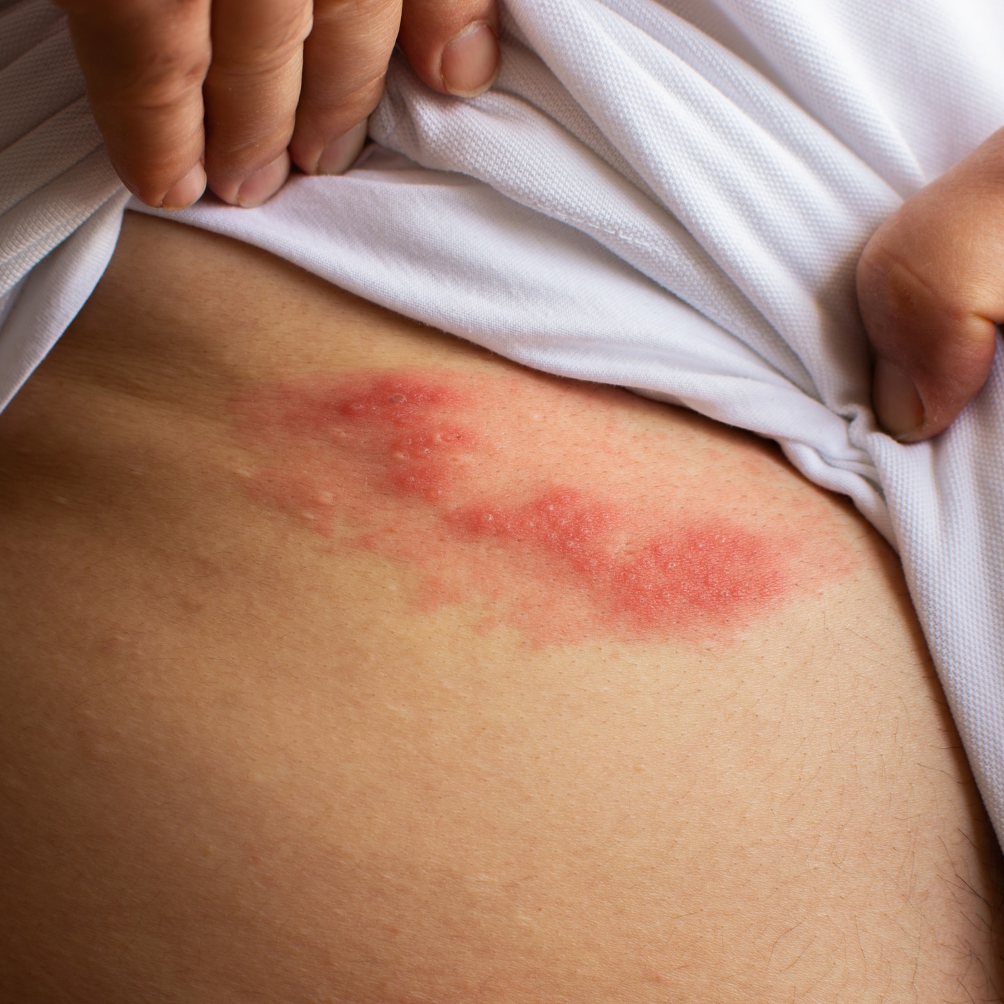 Shingles (herpes zoster) blister skin rash