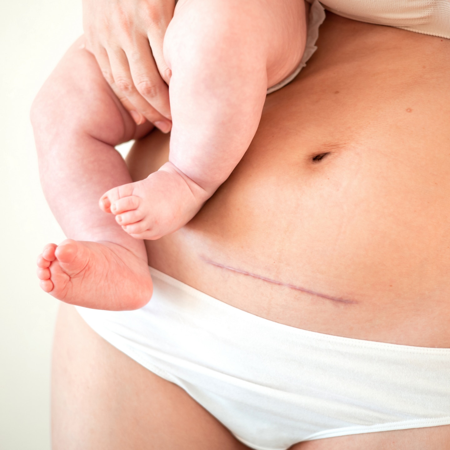 Mom's abdomen after cesarean section