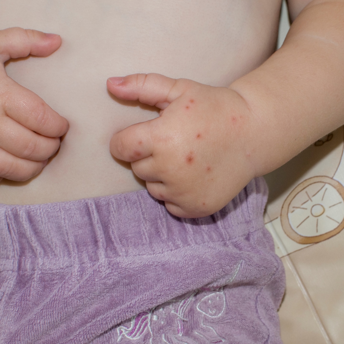 Hand-Mund-Fuß-Krankheit