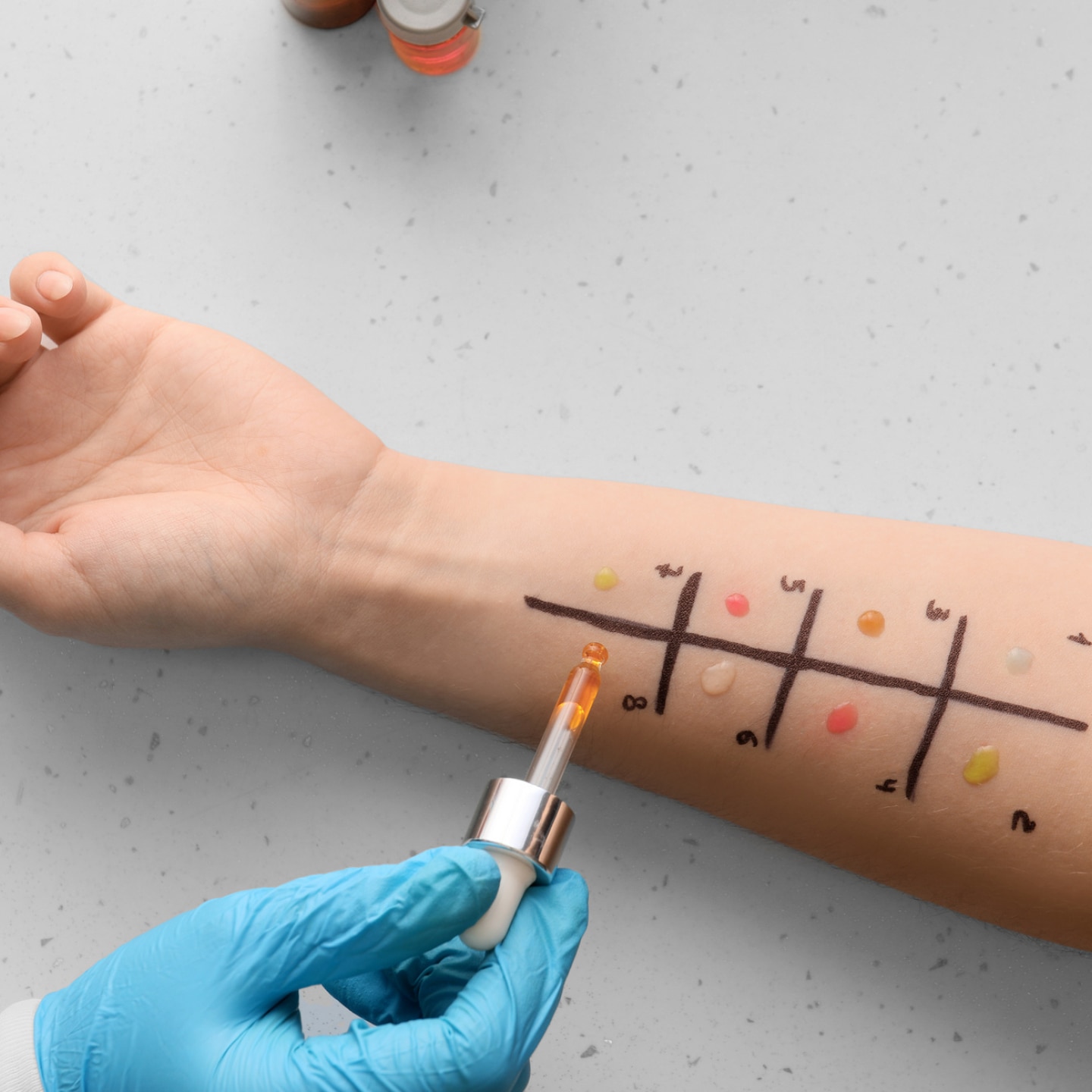 allergietest auf dem unterarm