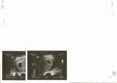 Bild zu Falls es euch interessiert... - Kinderwunschbehandlung