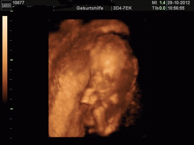 Bild zu FA Bericht + Outing + 3D Bild - Forum für März - Mamis