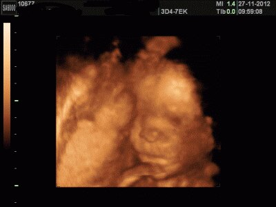 Bild zu Heute Zuckertest und nochmal 3D Foto - Forum für März - Mamis