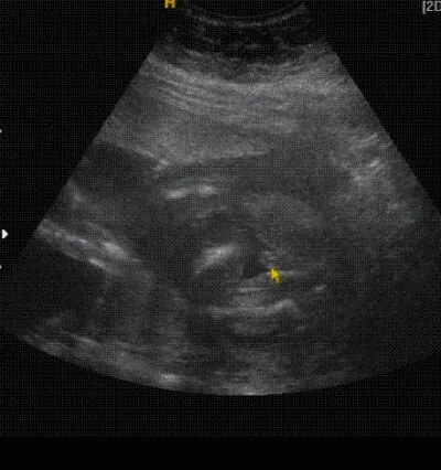 Bild zu Nabelschnur ??? - Forum für August - Mamis